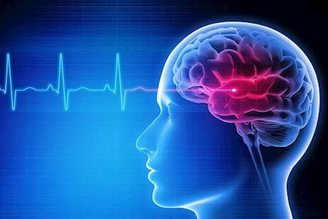 السكتة الدماغية يمكن الوقاية منها- إليك الطريقة "فيديوجرافيك"