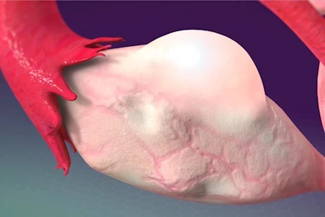 تعانين من تكيسات المبايض؟- 8 طرق لخفض التستوستيرون بجسمِك