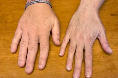 اضطراب ضخامة الأطراف.. كيف تحمي نفسك منه؟