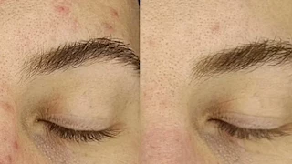 ثورة في عالم البشرة.. قناع ليلي قد يزيل التصبغات والندبات بـ4 ليال فقط