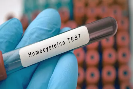 احذر ارتفاع الهوموسيستين.. هذه علاماته الأولى