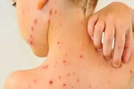 الفرق بين الحساسية والجدري المائي- هذه أوجه الاختلاف 