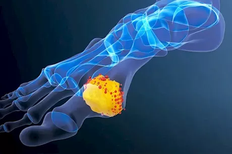 علاج ارتفاع حمض اليوريك في شهر- 7 طرق قد تساعدك