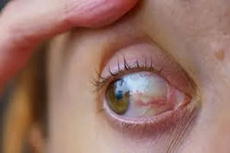 احذر- طبيب يوضح أمراض مزمنة تؤثر على العين