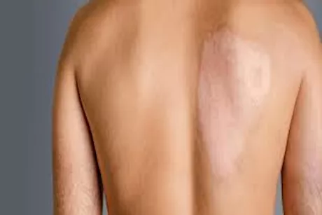 هل يقي الحمص من سرطان الجلد؟