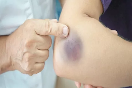 الكدمات.. بماذا تخبرك ألوان جسمك؟ 