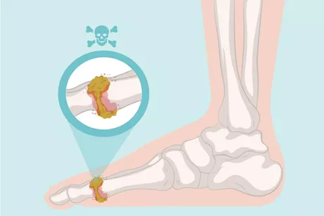 لا تفرط فيها- 6 أطعمة تزيد حمض اليوريك بجسمك