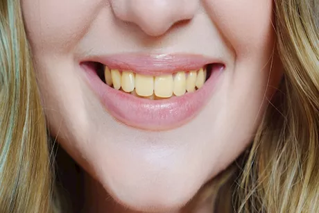 هل تناول الأدوية يسبب اصفرار الأسنان؟