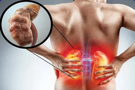 لا تتجاهلها- 7 أعراض أولية تكشف إصابتك بتلف الكلى