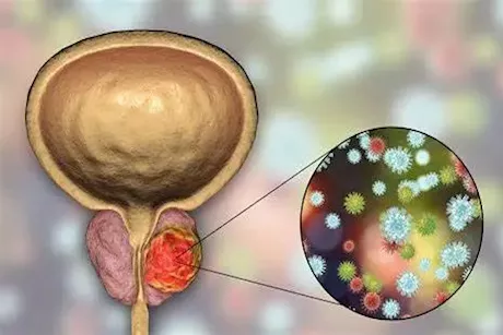 بعد الخمسين- 4 أطعمة تصيب الرجال بأورام البروستاتا