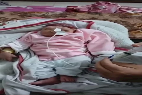 ولادة طفلة بدون دماغ في غزة.. طبيب يكشف أسباب صادمة