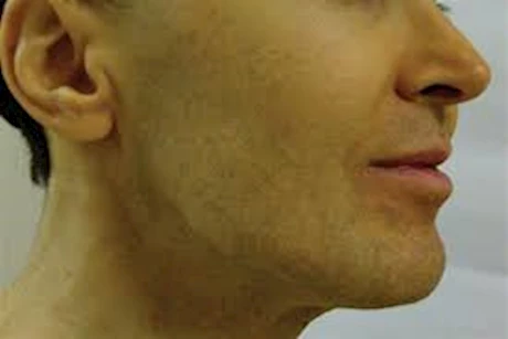 لمرضى الصفراء- أطعمة ممنوع تناولها