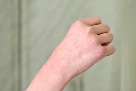 ما هو سبب تغير لون الجلد حتى مع استعمال واقي الشمس؟