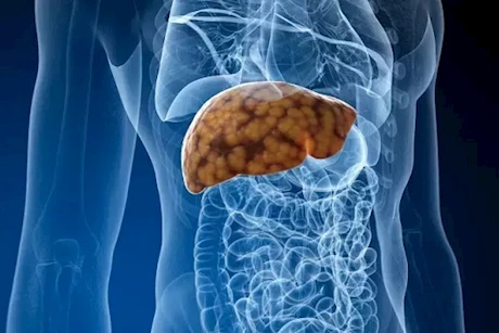 كيف يمكن الوقاية من دهون الكبد؟