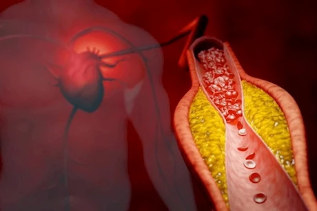 حسام موافي يكشف سن الإصابة بتصلب الشرايين