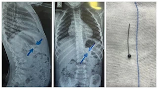 استخراج دبوس من معدة طفل في مستشفى سوهاج الجامعي -صور