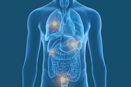 للنساء- 10 أعراض تكشف عن وجود أورام بجسدِك