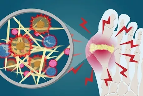 وداعًا لحمض اليوريك- 5 أطعمة نباتية لخفضه بالجسم