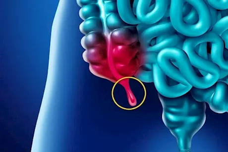 مرض شائع بين الشباب- 5 أعراض مبكرة تكشف عنه