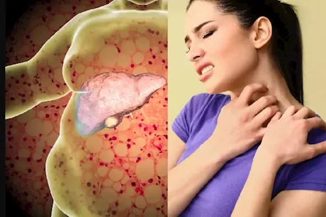 تظهر على الجلد- 4 علامات تخبرك بأن كبدك مريض