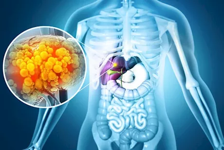 لعلاج دهون الكبد- تناول هذه المشروبات على الريق