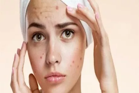 علاج حب الشباب بالليمون- هل هذا ممكن؟ طبيب يوضح