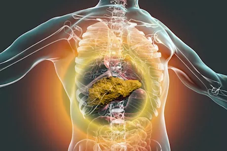 بسبب السكري- 6 أعراض تكشف إصابتك بتلف الكبد