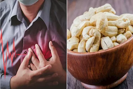 هل الكاجو يرفع الكوليسترول؟ طبيب يُجيب