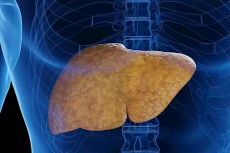 وداعًا لدهون الكبد- 4 وجبات خفيفة تساعد على علاجها