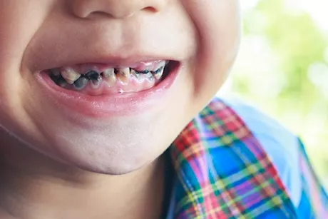 كيف تحمي أسنان طفلِك من التسوس؟- طبيب يجيب