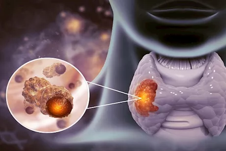حسام موافي يحذر: ورم الغدة الدرقية خطر في هذه الحالة