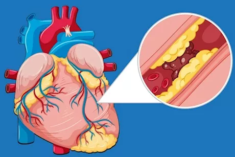 أسئلة وأجوبة عن انسداد القلب	