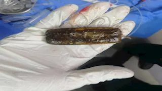 بالصور- استخراج موبايل من معدة مريض بعد عامين من ابتلاعه في أسيوط 