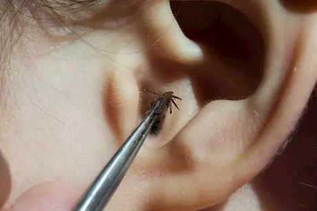 قد تفقد السمع- مضاعفات التعرض لحشرة بالأذن أثناء النوم
