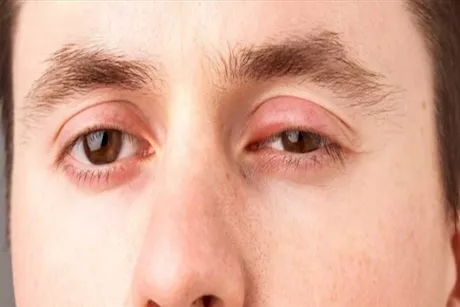 دليلك لعلاج تورم العين في المنزل