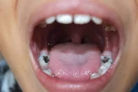 الحبهان يعالج تسوس الأسنان- حقيقة أم خرافة؟