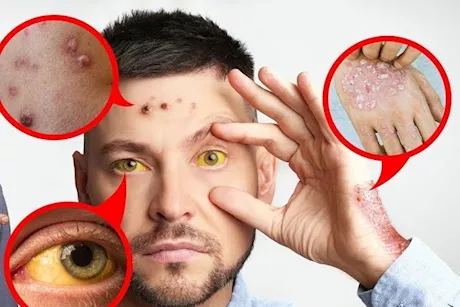 تظهر على الوجه- 10 علامات تخبرك بأن كبدك مريض