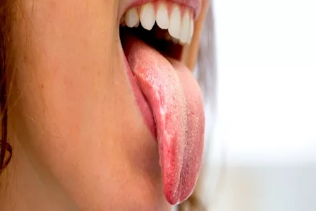 " السكري" أبرزها.. أمراض تسبب ظهور اللسان الجغرافي عند البالغين