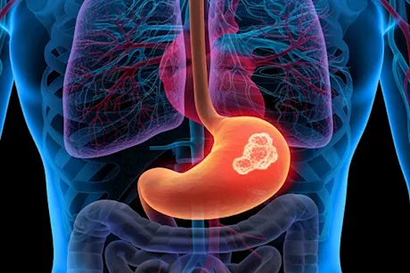 علامات صباحية تشير لإصابتك بأورام المعدة.. احذرها