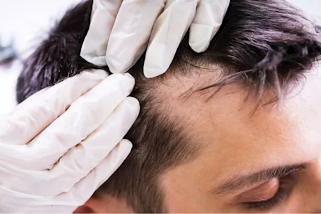 علاج دمامل الرأس- 5 طرق منزلية قد تخلصك منها