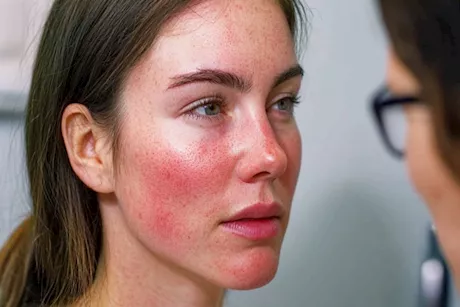 النساء أكثر عرضة للإصابة به- حقائق لابد أن تعرفها عن مرض الذئبة