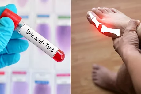 تتشابه مع بعض أمراض- 7 أعراض لارتفاع حمض اليوريك احذرها