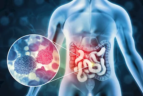 انتبه- 5 أعراض أولية تكشف إصابتك بأورام القولون