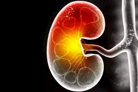 احذر- 5 أعراض تكشف إصابتك بمرض الكلى المزمن
