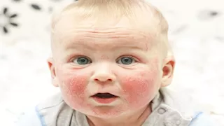 كيفية الوقاية من حساسية الطعام عند الأطفال؟