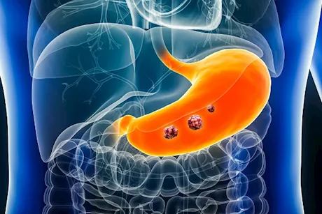 انتبه- 5 علامات مبكرة تكشف عن وجود ورم في معدتك