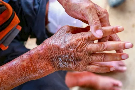 حسام موافي يحذر: هذا المرض يجعل جلدك مثل الجبس