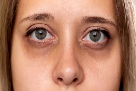 غير السهر.. 6 أسباب للهالات السوداء تحت العين