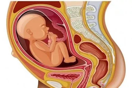 الطفل المقعدي خلال الحمل.. تعرف على الأسباب والعلاج