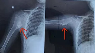 إنقاذ ذراع طفلة من البتر بعد استئصال ورم نادر بعملية دقيقة في سوهاج